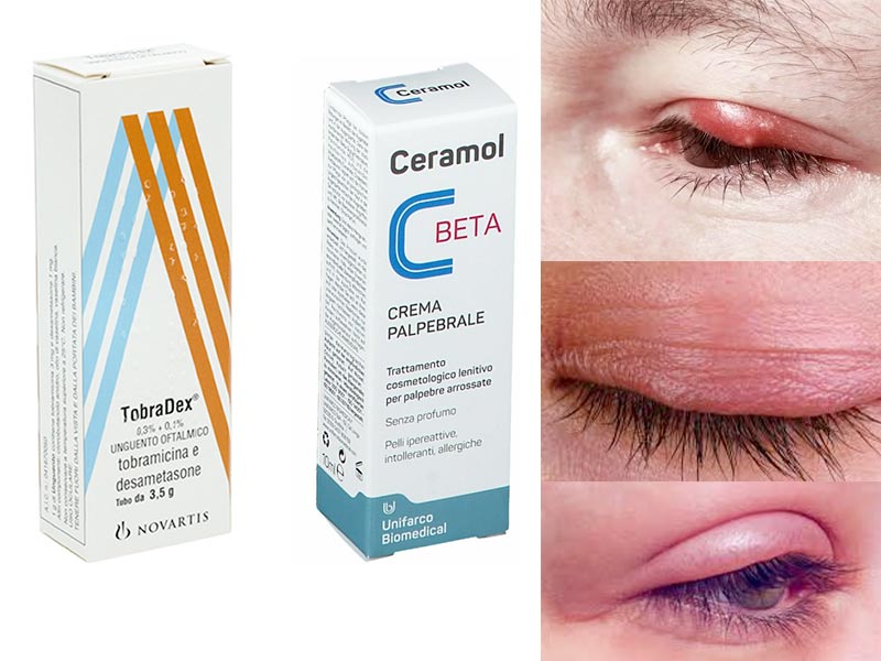 Crema para párpados Chalazion