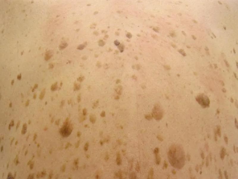 Crema eficaz de queratosis seborreica