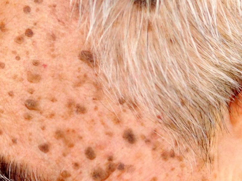 Cremas queratolicas para la queratosis seborreica