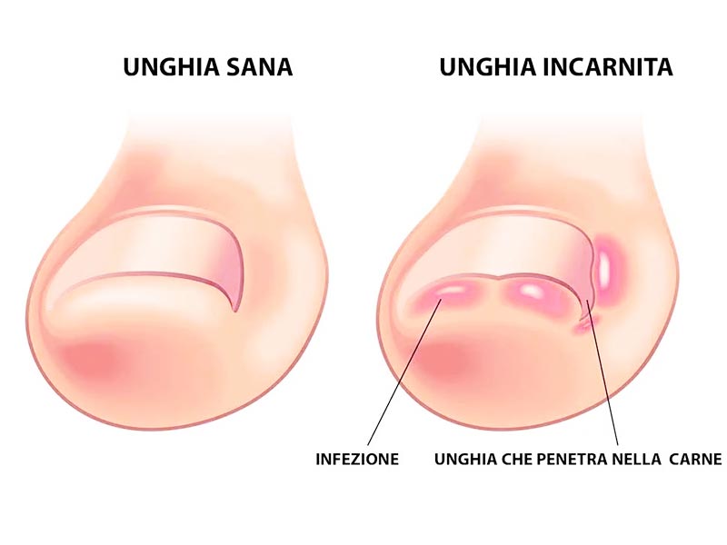 Cremas efectivas para uñas encarnadas