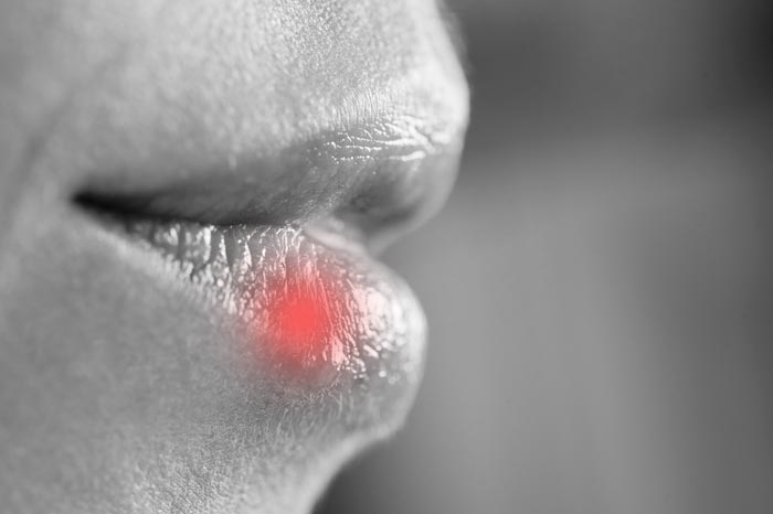 cremas efectivas para el herpes labial